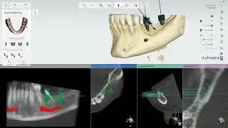 Bone guide Part 1/Костный шаблон Часть1