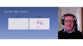 Clinical Experience with SonoTip TopGain EUS FNB needle