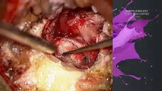 MAEAES REVESION MASTOIDECTOMY MICROSCOPE AND ECDOSCOPE ASSISTED EAR SURGERY
