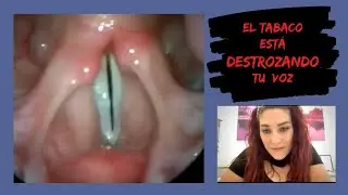 FUMAR arruina tu VOZ y daña CUERDAS VOCALES. Logopeda lo cuenta. Masterclass ERIZO escuela de Música