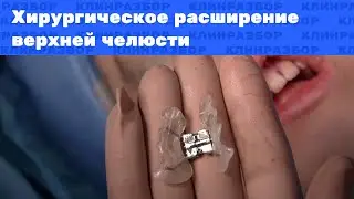 Операция: хирургическое расширение верхней челюсти
