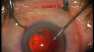 Facoemulsificación de catarata con pérdida de vítreo aspirando la corteza