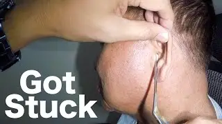 Cotton Bud Broke Off & Stuck in Elderly Man's Ear Removed