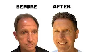 Men’s Hair Replacement System Install 😮