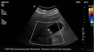 УЗИ. Желчнокаменная болезнь. Камни в желчном пузыре.