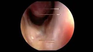 Allergie nasale papules