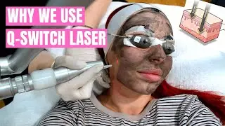 DERMAL TALKS: Why we use Q-switch Laser