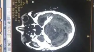 Brain bleeding CT
