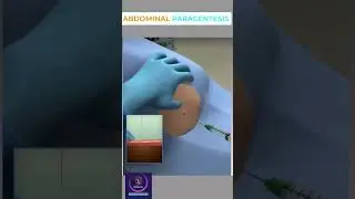 Abdominal Paracentesis Procedure 