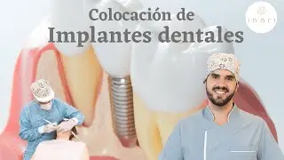 Colocación de Implantes dentales
