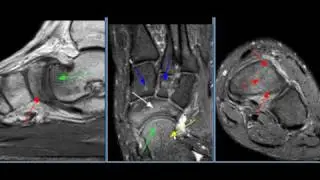 MRI Ankle Case 24