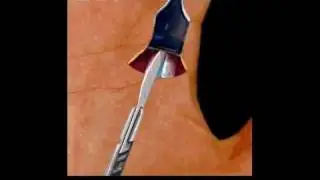 Trigger Finger Surgery