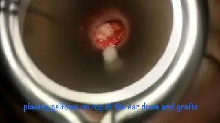 Artz - Cartilage Tympanoplasty Surgery