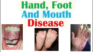 Hand, Foot and Mouth Disease | Viruses, Pathophysiology, Signs and Symptoms, Diagnosis, Treatment
