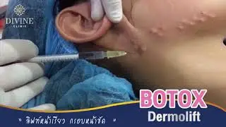ลิฟหน้าเรียว Botox