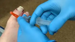 Nail Avulsion - treatment in the ER