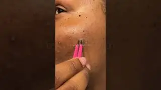 Pimple Patch Chronicles | Return from Barbados | #pimplepatch #omg