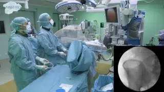 Placement of guidewire