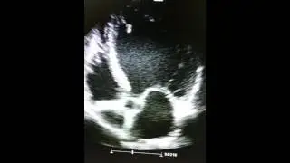 Chronic isquemic dilated cardiomiopathy. Up for CRTD.