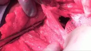 Mesh sutured repair of a flank incisional hernia