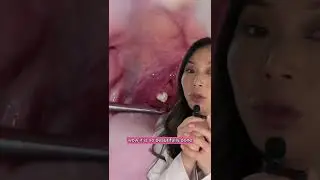WOW! The most graceful tonsil stone extraction ever! 
