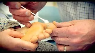 Freezing a HUGE PLANTAR WART (with liquid nitrogen) | Dr. Paul
