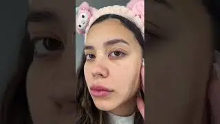No More Blackheads On My Nose 