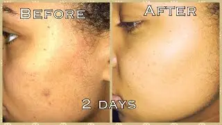 How To GET RID OF ACNE & DARK SPOTS in Days