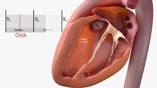 Mitral Valve ProlaPse for USMLE