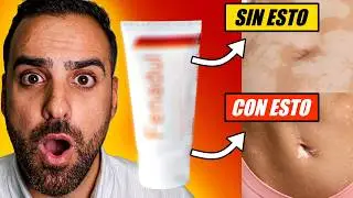Tratamiento Del VITILIGO | ¿Cómo SANARLO?