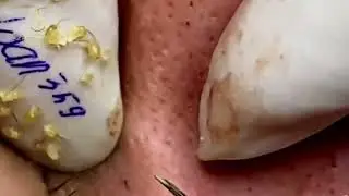 DIY Pimple and Blackhead Removal at Home