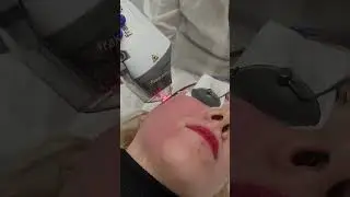 Fraxel skin rejuvenation