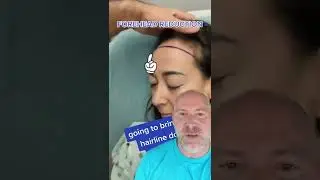 Forehead Reduction Surgery 😱 