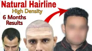 Best Hair Transplant Result 2020 || High Density || 6 months journey || Regrow Clinic Haridwar