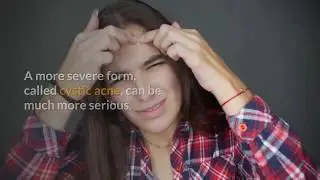 Acne Treatment: How to remove acne/pimple overnight
