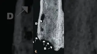 Amputation 31 THOUSAND YEARS AGO #shorts #ancient