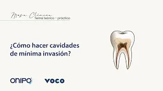 ¿Cómo hacer cavidades de mínima invasión?
