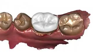 Making onlay crown in Exocad from IOS scan