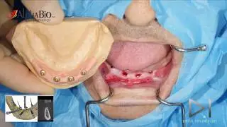 IMMEDIATE LOADING GUIDED SURGERY ATROPHIC MANDIBLE dr.Giampiero Ciabattoni Digital Implantology