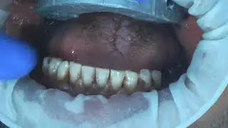 Upper Full mouth jaw relation, Bite rim scanning with trios 3 by Dr.Nevetha #implantdentistry