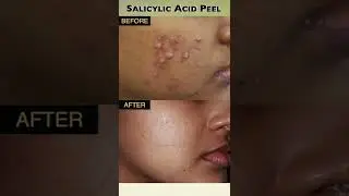 Effective Salicylic Peel Results 😍 | Best Treatment for Hyperpigmentation, Acne, and Pimple Marks