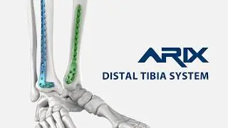[ARIX OS] Arix Distal Tibia System - Surgical Guide Animation