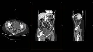 Abdominal Imaging Call Prep Cases: C​l​o​s​e​d​ ​L​o​o​p​ ​SBO​ ​(​C​T​) Search Pattern