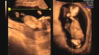 Laura's Ultrasound, January 31st 2013