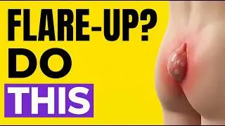 How To Get Rid Of Pilonidal Cysts At Home
