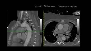Ductus diverticulum vs Pseudoaneurysm