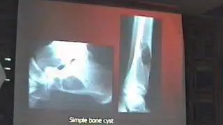 Bone tumers 2