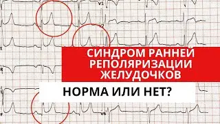 Синдром ранней реполяризации желудочков. Норма или патология?!