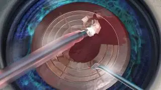 Introducing the LenSx Laser for cataract surgeries