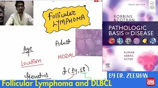 Follicular lymphoma & Diffuse large B Cell Lymphoma (DLBCL) #neet_pg_2022  #inicet ft.Robbin’s patho